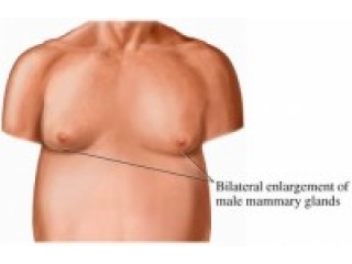 Гинекомастия - что нужно знать?
